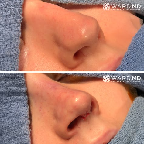 Tip Rhinoplasty Before After, Nose Job Tip Reduction, Rhinoplasty Bulbous Tip, High Radix Nose, Nose Rhinoplasty Before After, Nose Job Bulbous Tip, Bulbous Nose Job, Upneeq Before And After, Nose Job Before And After Front View