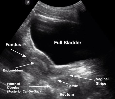 Learn to use Gynecology/Pelvic Ultrasound to: Identify indications for pelvic ultrasound evaluation Perform a pelvic ultrasound exam using Transabdominal and Transvaginal techniques Evaluate patients for common gynecologic pathologies using ultrasound Identify emergent gynecologic cases requiring referral Uterus Ultrasound, Ultrasound Technician School, Diagnostic Medical Sonography Student, Ultrasound School, Ultrasound Physics, Obstetric Ultrasound, Medical Radiography, Nursing Study Tips, Vascular Ultrasound