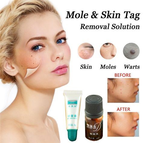 Sale Mole Pores and skin Tag Removing Resolution Painless Mole Pores and skin Darkish Spot Removing 1pc Face Wart Tag Freckle Removing and 2pcs Restore Cream Check more at https://beauty-and-health.catalogmargo.com/sale-mole-pores-and-skin-tag-removing-resolution-painless-mole-pores-and-skin-darkish-spot-removing-1pc-face-wart-tag-freckle-removing-and-2pcs-restore-cream/ Face Warts, Skin Moles, Mole, Beauty Makeup, Resolution, Cream, Skin, Health, Tags