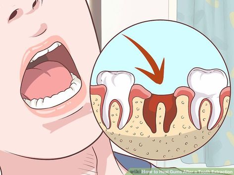 How to Heal Gums After a Tooth Extraction (with Pictures) Eating After Tooth Extraction, Wisdom Teeth Swelling, Wisdom Teeth Recovery, Tooth Pain Remedies, Wisdom Teeth Pain, Tooth Extraction Aftercare, Tooth Extraction Healing, Teeth Surgery, Cracked Tooth