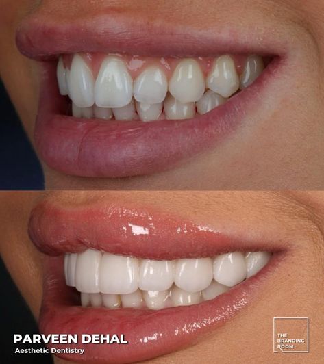 ✨ Smile Transformation by Dr. Parveen Dehal! ✨ Check out this incredible before-and-after! Using custom-crafted veneers, Dr. Parveen Dehal has created a beautifully natural, radiant smile that brings out the patient’s confidence. From shade to shape, each veneer is expertly designed to enhance facial harmony and brighten their look. 🌟 Ready to transform your smile? Book a consultation with Dr. Parveen today and start your journey to a stunning new smile! 🦷💫 #DentalHealth #ProtectYourSmile #... Facial Harmony, Smile Transformation, Smile Book, Aesthetic Dentistry, The Patient, Your Smile, Dental Health, Room Aesthetic, Facial