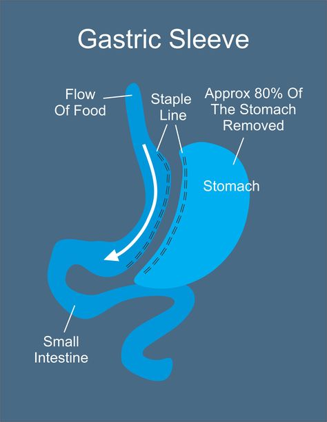 Gastric Sleeve vs Gastric Bypass Overview Gastric Bypass Sleeve, Vertical Sleeve Gastrectomy, Bariatric Sleeve, Bariatric Surgeon, Sleeve Gastrectomy, Sleeve Surgery, Gastric Bypass, Bariatric Recipes, Bodybuilding Motivation