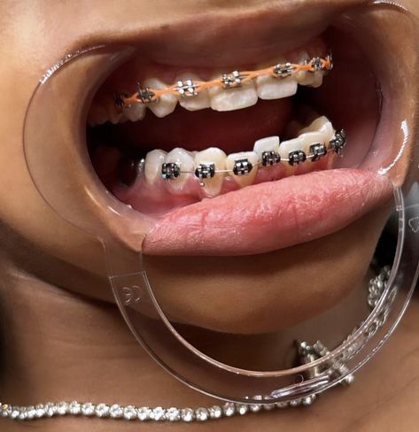 Powerchain Braces Aesthetic, Power Chains, Braces Aesthetic, Braces Colours, Braces Journey, Dental Braces Colors, Braces Rubber Bands, Power Chain, Cute Braces Colors