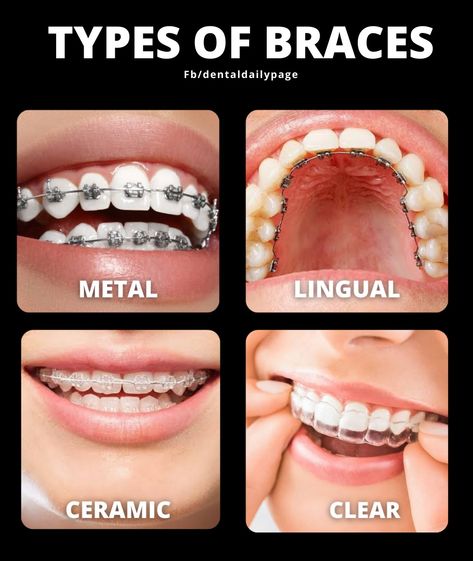 Top Braces Only Teeth, How To Put Braces On Teeth, Type Of Smiles, Star Braces, Color Of Braces, Braces Types, Perfect Teeth Braces, Brackets Aesthetic, Different Types Of Teeth