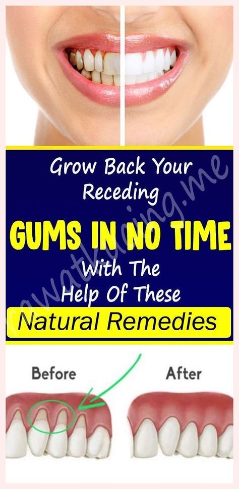 Grow Back Your Receding Gums With The Help Of These Natural Remedies Mm Recipes, Breastfeeding Nutrition, Holistic Health Nutrition, Nutrition Infographic, Swollen Gum, Gum Recession, Healthy Facts, Health Articles Wellness, Integrative Nutrition