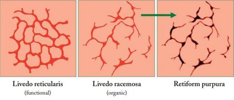 Livedo Reticularis, Dermatology Office, Anatomy Bones, Invisible Disease, Autoimmune Disorder, Dermatology, Disease, Medicine