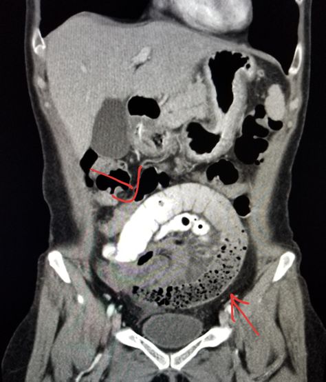 #Abdomen #CT: small #intestine #obstruction (#SBO) in pt. with pain and vomiting. #radiologist #radiology #pain Pet Ct, Small Intestine, Diagnostic Imaging, Medical School Essentials, Ct Scan, Medical Studies, School Essentials, Radiology, Medical School