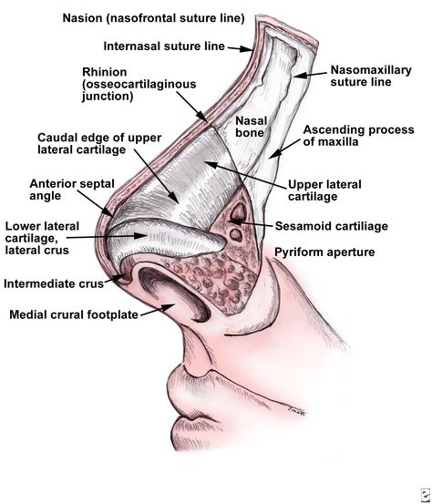 Nasal  Anatomy: Nasal skin has an abundant blood supply and tends to be thinner over the rhinion and thicker over the nasion. Nasal skin thickness varies among individuals.The nasal pyramid is composed of 2 nasal bones and the frontal process of the maxilla. The thickness of the bones decreases toward the tip of the nose; as a result, most fractures occur in the lower half.Upper lateral cartilages form the middle nasal vault. Upper lateral cartilages are attached to the nasal bones superiorly, t Nasal Septum Anatomy, Nose Anatomy Medical, Bone Drawing, Nasal Septum, Nasal Cavity, Bone Fracture, Medical Anatomy, Notes Inspiration, Medical Knowledge