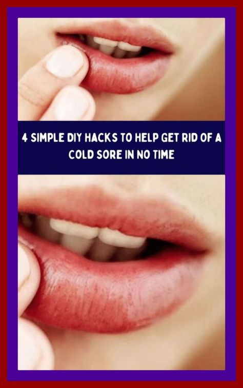 Get Rid of Herpes By Using a Simple Trick Fast Cold Sore Remedy, How To Heal A Cold Sore Fast, How To Treat Cold Sores Fast, How To Stop A Cold Sore Before It Starts, Lysine For Cold Sores, Home Remedy For Cold Sore On Lip, How To Get Rid Of A Cold Sore Fast, How To Get Rid Of Cold Sores, How To Get Rid Of Cold Sores Overnight