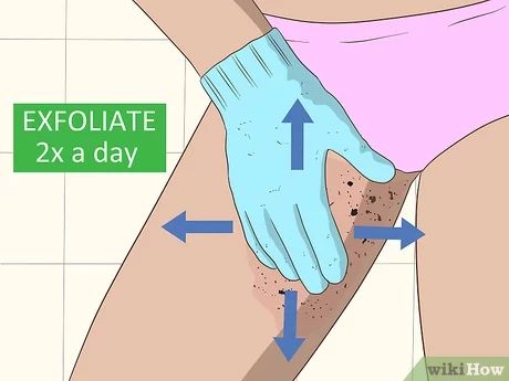 3 Ways to Remove an Ingrown Hair - wikiHow Ingrown Hair Remedies Pubic Area, How To Remove Ingrown Hair, Ingrowing Hair, Treat Ingrown Hair, Ingrown Hair Remedies, Ingrown Hair Removal, Prevent Ingrown Hairs, Ingrown Hairs, Step By Step Hairstyles