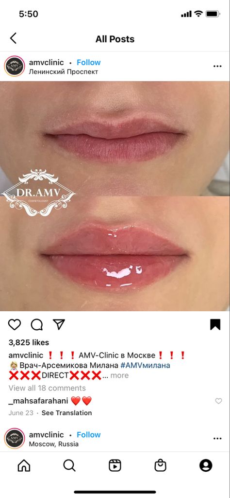 Pouty Lips Injections, Lip Filler Pouty Lips, Lip Filler Inspiration Natural, Lip Inspo Filler, Natural Looking Lip Fillers, Hip Filler, Lip Filler Shapes, Pouty Lip Filler, Lip Filler Natural