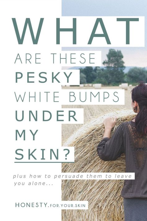 Do you have any of these pesky white, hard bumps under your skin? They are most common around the eyes, but also right 'plonk' in the middle of your chin... These pesky white bumps look like spots, but they don't go through that cleansing Mount.Vesuvius spot stage... today I'll demystify the white skin bumps for ya & let you in on how to treat these bad boys... #TakeControlOfTheWhiteBumps *winks* http://wp.me/p6LuQS-Or White Bumps On Face, Bumps Under Eyes, Make Up Salon, Temple Spa, Skincare Habits, Skin Bumps, Acne Help, Low Estrogen, Acne Skincare Routine