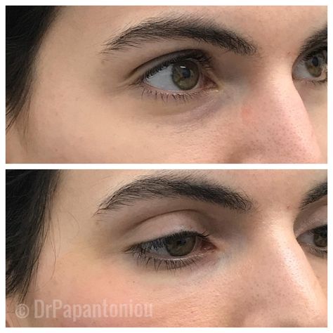 Get ready for the New Year looking refreshed! Call today! 6313777245 for your appointment. This before and after of under eye filler with Restylane shows a subtle correction of dark circles and volume loss. . . #drpapantoniou #simplydermatology #skincare #simplycollection #fillers #naturalskincare #BOLI #bestoflongisland #beforeandafter #finelines #wrinkles #cosmeticdermatology #medicaldermatology #beforeandafters #expertinjector #longislandexpertinjector #nyexpertinjector #balanceiseverything Under Eye Filler, Eye Filler, Under Eye Fillers, New Years Look, Cosmetic Dermatology, Dermal Fillers, Skin Tips, Dermatology, Dark Circles