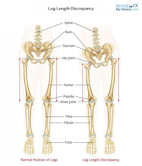 Leg Length Discrepancy, Leg Length Discrepancy Exercise, High-cut Leg Lace Bottoms With Lace Trim, Physiotherapy Cheat Sheet, Lower Limb Anatomy Notes, Pelvic Diaphragm Anatomy, Womens Health