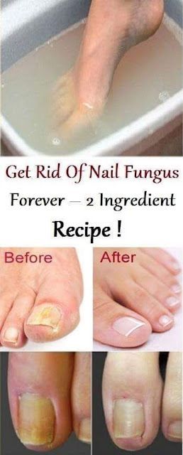 A fungal nail occurs when a fungus attacks a toenail fingernail or the skin under the nail. Any part of the body can be affected by fungal infection 2 Ingredient Recipes, Weight Watchers Snacks, Weight Watchers Desserts, Natural Healing Remedies, Diy Remedies, Toenail Fungus, Fungal Infection, 2 Ingredient, Nail Fungus