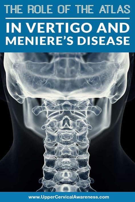 Vertigo is a false sensation that a person or his surroundings are spinning. It is the primary symptom of Meniere’s disease. Vertigo episodes caused ... Meniers Disease, Meneires Disease, Home Remedies For Vertigo, Dizziness Remedies, Vertigo Causes, Ear Diseases, Upper Cervical Chiropractic, Vertigo Relief, Vertigo Remedies