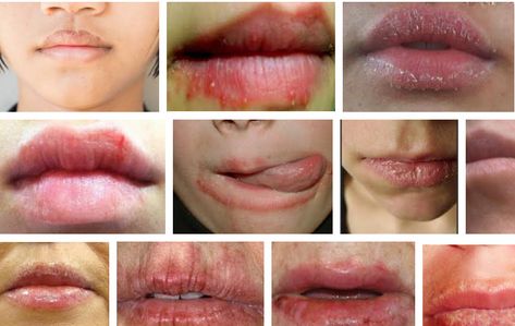 Eczema on the lips, also called lip dermatitis or eczematous cheilitis, causes a characteristic redness, drying, and scaling of the lips. Lip Blister Remedy How To Get Rid, Chapped Skin Around Mouth, How To Get Rid Of Chapped Lips Fast, How To Get Rid Of Allergies Fast, Lip Blister, Lip Infection, Lip Allergy, Ariel Room, Blister On Lip