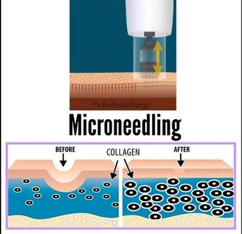 Microneedling Skinpen, Microneedling Before And After, Skinpen Microneedling, Benefits Of Microneedling, Dermapen Microneedling, Skin Care Diy, Skin Anatomy, Esthetician Quotes, Skin Needling