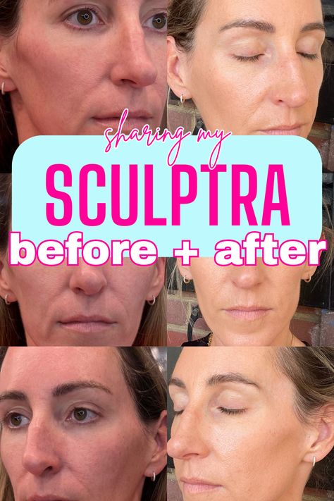 Why I Decided To Get Sculptra   My Sculptra Before and After Thermage Before And After, Facial Balancing Before And After, Sculptra Before And After Faces, Cool Sculpting Before And After, Mini Face Lift Before And After, Sculptra Before And After, Sculptra Filler, Ultherapy Before And After, Juvederm Before And After