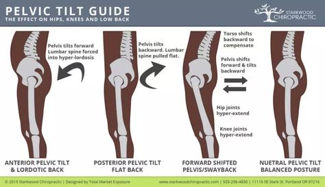 Fixing Posterior Pelvic Tilt - Hip Tilt Causes & Fixes Tilted Pelvis Symptoms, Rotated Pelvis, Tilted Pelvis, Posterior Pelvic Tilt, K Tape, Psoas Release, Posture Fix, Pelvic Tilt, Posture Exercises