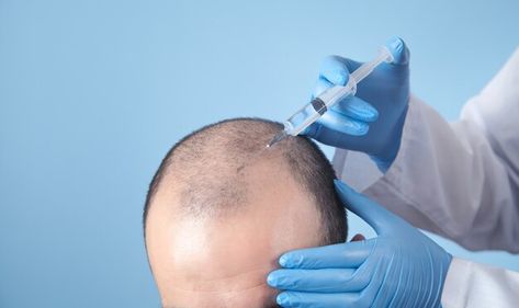 Hair Implants, Hair Transplant Cost, Hair Transplant Procedure, Fue Hair Transplant, Hair Transplant Surgery, Best Hair Transplant, Hair Clinic, Lost Hair, Hair Transplant