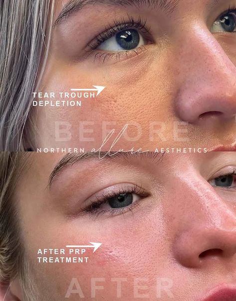 Under Eye Prp Before And After, Prp Before And After, Prp Injections Under Eyes, Prp Microneedling Before And After, Prp Undereye Before And After, Vampire Facial Before And After, Microneedling Before And After, Prp Microneedling, Prp Facial