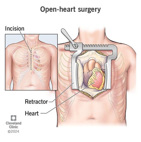 Open-heart surgery can treat heart problems like heart failure, arrhythmias, aneurysms and coronary artery disease. Open-heart surgery procedures may include CABG (bypass surgery), heart transplant, valve replacement and surgeries to fix issues present at birth. Bypass Surgery Heart, Heart Surgery Recovery, Heart Valve, Medical Illustrations, Coronary Artery, Heart Surgeon, Heart Valves, Open Heart Surgery, Bypass Surgery