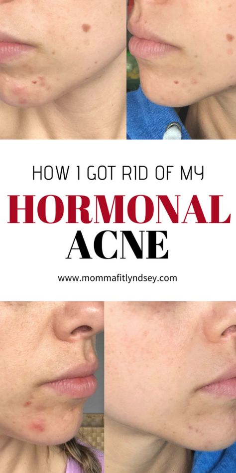 how to get rid of hormonal acne Home Remedy For Face Acne, How To Get Rid Of Redness On Face From Acne, Acne Chin And Jaw, How To Get Rid Of Acne Around Mouth, Cystic Acne Diet Plan, How To Keep Your Face Acne Free, Clear Chin Acne, Clyndamiacin For Acne, How To Get Rid Of Chin Acne Overnight