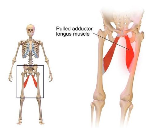 Groin injuries comprise up to  5 % of all sports injuries. In competitive football the numbers increase up to 25%.A groin strain causes sharp pain or spasms in the groin area or lower abdominal region. The pain can quickly resolve, or it can persist, developing into a throbbing pain at rest with sharp stabs of pain when you try to move your leg or walk. Inner Thigh Muscles Anatomy, Stretches For Groin Strain, Groin Strain Exercises, Pulled Groin Muscle In Women, Groin Exercises, Thigh Muscle Pain, Adductor Longus, Groin Strain, Groin Injury