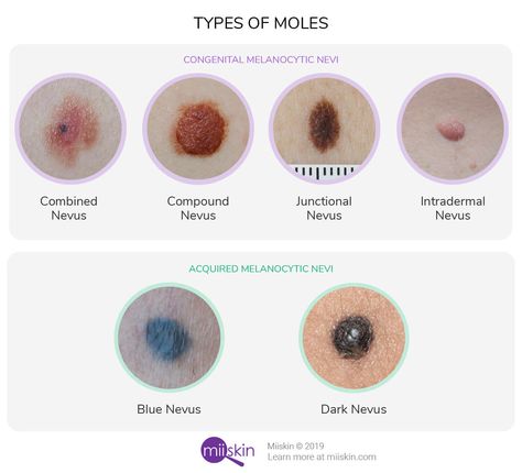 Extensive mole guide with images. Learn about birthmarks, moles and how a common benign mole (nevus) normally looks like. White Mole, Mole Meaning, Facial Mole, Cancerous Moles, Moles On Face, Dark Mole, Skin Mapping, Red Moles, Skin Moles