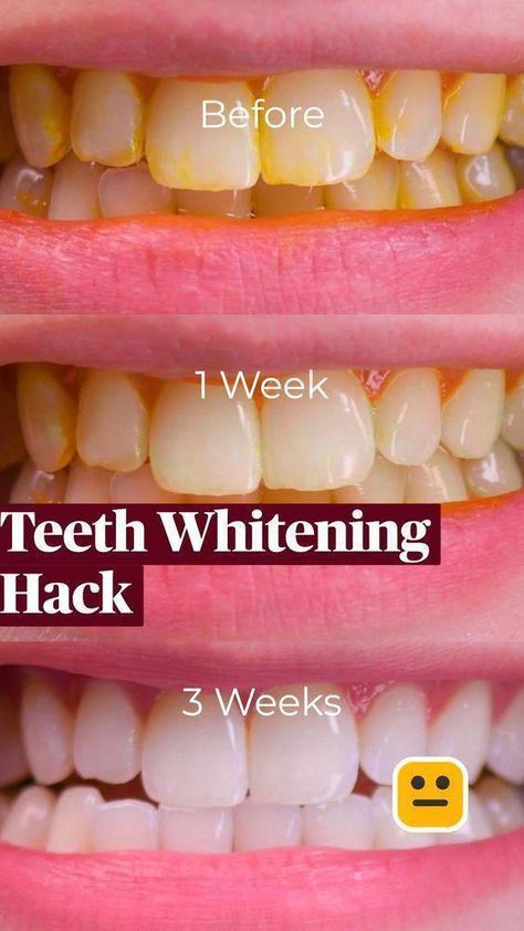 Fix tooth decay and Receding Gums Naturally At Home #whitingteeth #teethwhiting #teethcare #healthyteethtips #healteethnaturally #WhyIsOralCareSoImportant #WhatIsThePurposeOfOralCare #HowToCareForOralHealth Fix Teeth, Teeth Aesthetic, Whiten Your Teeth, Yellow Teeth, How To Prevent Cavities, Oral Care Routine, Receding Gums, Natural Teeth Whitening, Teeth Care