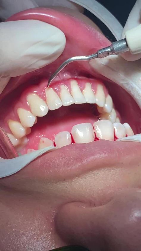 Remove Tartar And Plaque From Teeth In minutes!������✨ #TartarRemoval #DentalCare #OralHealth #DentalHygiene #Tartar #HealthyTeeth #OralCare #DentalTips #TartarPrevention #SmileCare #ImportanceOfOralHealthCare Dental Wallpaper, Tartar Removal, Dental Posts, Dental Videos, A Balanced Diet, Oral Health Care, Healthy Smile, Dental Hygiene, Tooth Decay