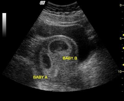 8 week- twins: This ultras was 8 weeks along. My husband and I were super shocked to find out we are having twins. These will be our 2nd and 3rd Twins Sonogram Ultrasound, Twin Sonogram Ultrasound, Ultrasound Pictures Twins, Twin Ultrasound Pictures, Identical Twins Ultrasound, Ultrasound Pictures 8 Weeks, 5 Weeks Pregnant Ultrasound, Ultrasound Prank, Twin Ultrasound