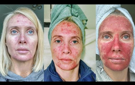 This Woman’s Graphic Photos Expose The Painful Dangers Of Tanning Profractional Laser Before And After, Laser Resurfacing Before And After, Prp Face Before And After, Face Cupping Before And After, Facial Cupping Before And After, Dermabrasion Before And After, Chemical Peel Before And After, Microneedling Before And After, Dermaplaning Before And After