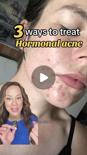 Acne Tips And Tricks, Acne Around Mouth And Chin, How To Treat Hormonal Acne, How To Clear Hormonal Acne, What Acne In Different Places Means, Hormonal Acne Tips, How To Get Rid Of Hormonal Acne, Types Of Acne And How To Treat, Skin Care Solutions Acne