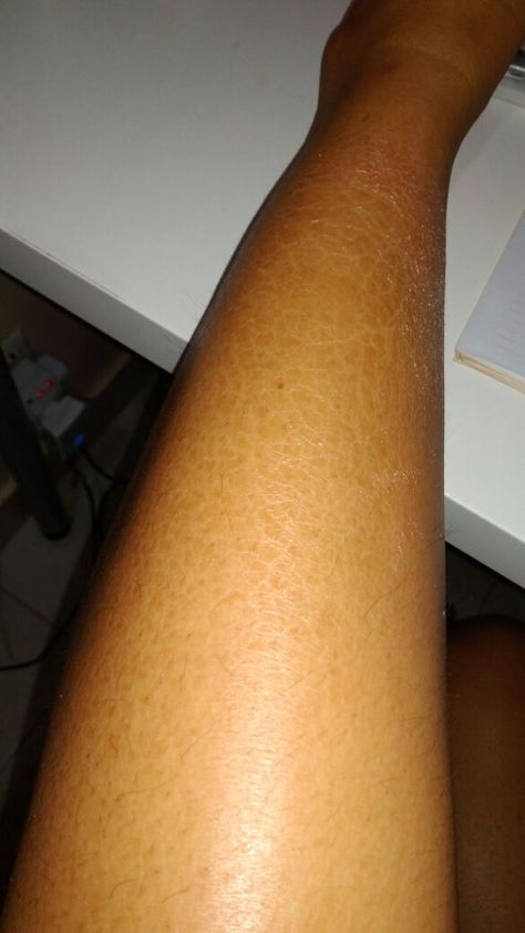 Scaly Skin (Ichthyosis Vulgaris) Ichthyosis Vulgaris, Scaly Skin, Marriage Advice, Fitness Tips, Geek Stuff, Skin, Health, Quick Saves