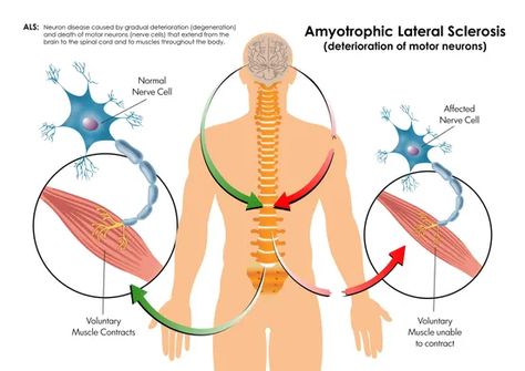 Lou Gehrigs Disease, Motor Neuron, Massachusetts General Hospital, Harvard Medical School, Nerve Cell, Spinal Cord, Central Nervous System, Neurology, Clinical Trials