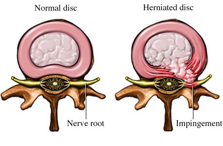 Nerve impingement. A pinched nerve Severe Neck Pain, Lumbar Disc, Bulging Disc, Disk Herniation, Spinal Nerve, Pinched Nerve, Spine Surgery, Sciatica Pain, Nerve Pain