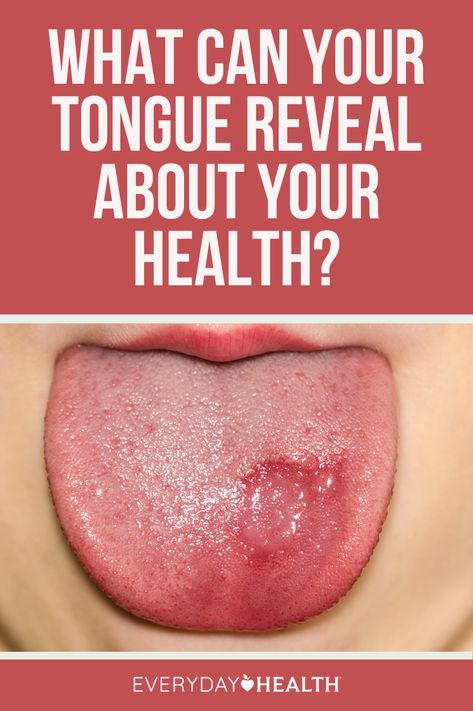 Your tongue does a lot more than taste. It’s even part of your immune system. Black Tongue Smooth Tongue White Patches on Tongue White or Red Spots or Lesions Yellow Tongue The color, texture, and coating of the tongue can provide clues about what’s going on with your health. Ulcer On Tongue, Lingual Tonsils, Yellow Tongue, Tongue Sores, Homemade Facial, Black Tongue, Tongue Health, White Patches, The Tongue