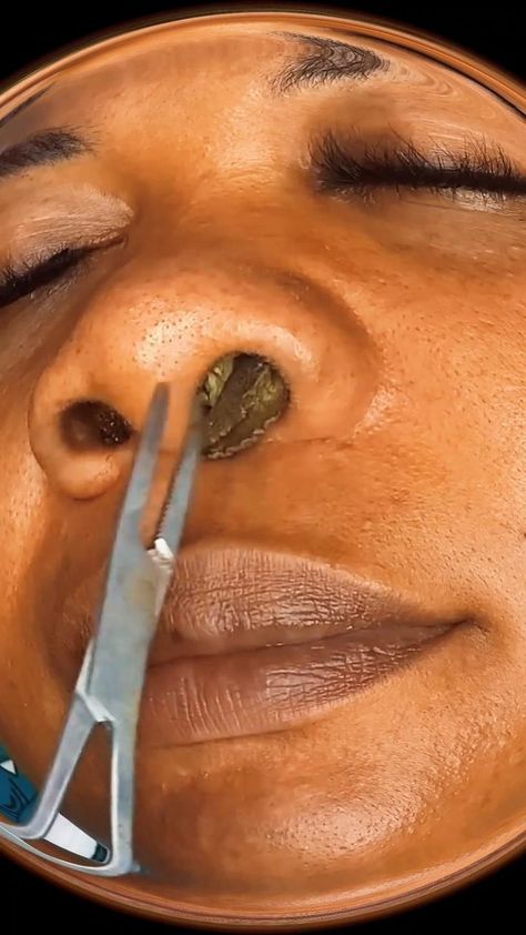 Create Pin for ad Hard Pimple, Satisfying Zit Popping Videos, Popping Pimples, Blackhead Scrub, Create Pin, Skin Lesions, Pimple Extractor, Zit Popping Videos, Get Rid Of Pimples