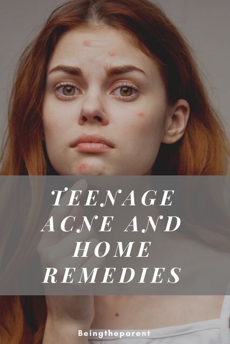 Teenage Acne Skincare Routine Homemade, Forehead Acne Home Remedies, Teenage Acne Skincare Routine, Teen Facial, Natural Wrinkle Remedies, Teen Activities, Teenage Acne, Forehead Acne, Teen Stuff