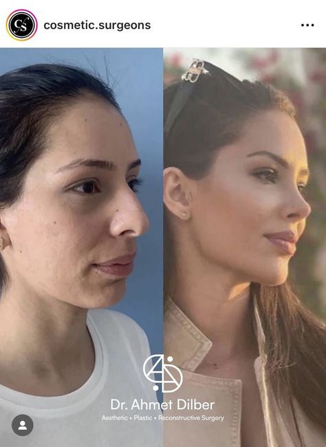 #plasticsurgery #plasticsurgerygonewrong #beforeafter #celebritiesbeforeafter #hollywoodstars #bignosesurgery #surgery #facesurgery #vlinesurgery #koreanplasticsurgery #kpopplasticsurgery #nosejob #jawreductionsurgery #eyesurgery #cheekfillers #rhinoplasty #facelift #plasticsurgeryfails #expensiveplasticsurgery Makeup Skin Tone, Before And After Makeup Transformation, Nose Surgery Rhinoplasty, Cheek Implants, Face Transformation, Plastic Surgery Fail, Chin Augmentation, Chin Implant, Rhinoplasty Nose Jobs