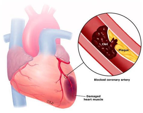 Heart attack is mainly caused by not getting enough blood to heart tissues, by variety of means, one of the main is the condition shown here Constant Headaches, Coronary Arteries, High Cholesterol, Clean Out, Juice, Matter, Glass