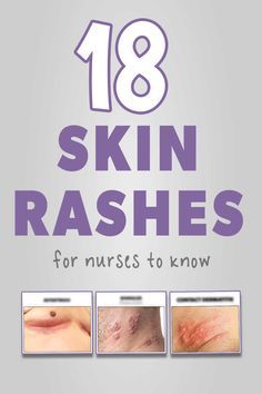 Skin Disorders Nursing, Rashes Types Of Skin, Pediatric Rashes, Skin Infections Types Of, Skin Rashes Pictures Types Of, Rashes On Skin, Homemade Tartar Sauce Easy, Skin Conditions Pictures, Skin Rash Remedies