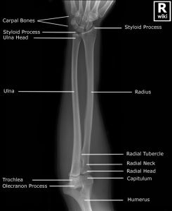 From WikiRadiography: http://radiologypics.com/2013/03/19/radiographic-anatomy-of-the-forearm/ Forearm Anatomy, Anatomi Dan Fisiologi, Radiology Schools, Medical Radiography, Radiology Humor, Radiologic Technology, Radiology Student, Radiology Imaging, Xray Technician