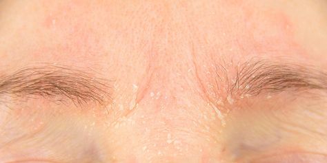 Eyebrow Dandruff Is a Thing—Here’s How to Treat It Eyebrow Dandruff, Eyebrow Art, Flat Tummy Tips, Dandruff Solutions, Dandruff Remedy, Flaking Skin, Snoring Solutions, Flaky Scalp, Eye Sight Improvement