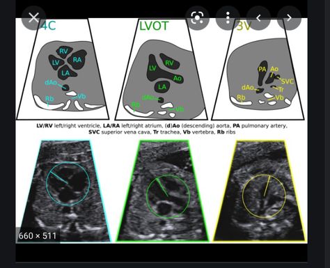 Ultrasound Video, Heart Ultrasound, Ultrasound Notes, Diagnostic Medical Sonography Student, Ultrasound School, Obstetric Ultrasound, Cardiac Sonography, Sonography Student, Vascular Ultrasound