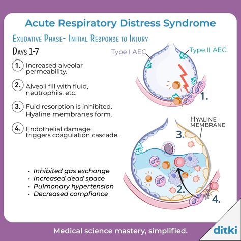 ARDS is characterized by acute dyspnea, hypoxemia, and pulmonary infiltrates. Learn more: https://ditki.com/course/pathology/glossary/pathophysiologic-disorder/acute-respiratory-distress-syndrome #ditki #usmle #meded #medschool #medstudent #highered #mededonline #lunginflammation #pathology #acuterespiratorydistresssyndrome #respiratorypath #nursing #pance #physicianassistant #osteopath #allopath #medicine #science #healthscience #nurse #premed #mcat #mbbs Hypoxemia Nursing, Peptic Ulcers Nursing, Paramedic Study, Acute Respiratory Distress, Clinical Pathology, Med Notes, Nurse Education, Gas Exchange, Respiratory Distress