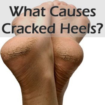 What Causes Cracked Heels, Homemade Foot Cream, Cracked Heel Remedies, Dry Heels, Liver Detoxification, Cracked Heels, Detox Your Body, Foot Cream, Foot Health