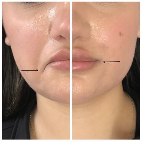 Sharing our favorite transformations from September🌟 Each one represents a boost of confidence and a well-deserved moment of self-care. Treat yourself to a little glow and discover how a fresh look can make all the difference✨ (Slide 2: Lip Filler, Slide 3: Chin Filler, Slide 4: Brow Lamination & Tint, Slide 5: Lip Flip, Slide 6: Sculptra, Slide 7: Brow Lamination and Tint, Slide 8: Tox, Slide 9: DAO Tox, Slide 10: Brow Lamination and Tint) #nashvillemedspa #nashvillewellness #medspanashvil... Dao Botox Before After, Lip Corner Lift, Brow Lamination And Tint, Botox Lip Flip, Botox Results, Lip Flip, Chin Filler, Botox Before And After, Face Fillers